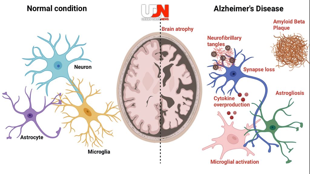 Alzheimer: Identifikasi, Penyebab, dan Gejala yang Harus Diketahui